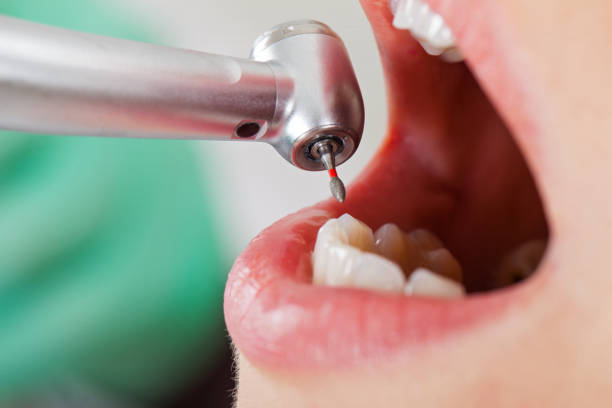 Best Emergency Treatment for Toothache in Cedar Bluff, AL